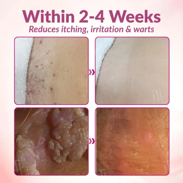 Piguiay® Femina HPV Relief Gel✨𝐄𝐟𝐟𝐞𝐜𝐭𝐢𝐯𝐞 𝐑𝐞𝐥𝐢𝐞𝐟 𝐟𝐫𝐨𝐦 𝐇𝐏𝐕 𝐒𝐲𝐦𝐩𝐭𝐨𝐦𝐬✨