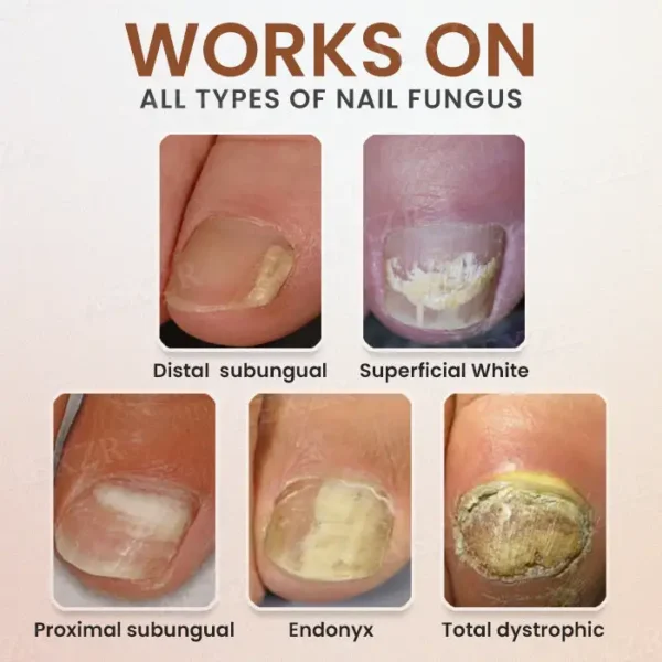 Piguiay® Nails Repairing Serum