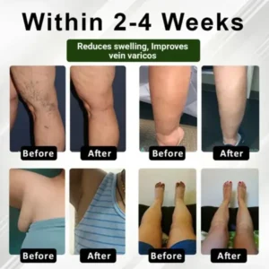 Zakdavi™ FluidEase Leg Therapy Edema Cream