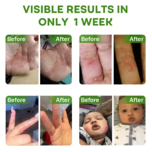 Piguiay® Herbal Psoriasis Relief Cream