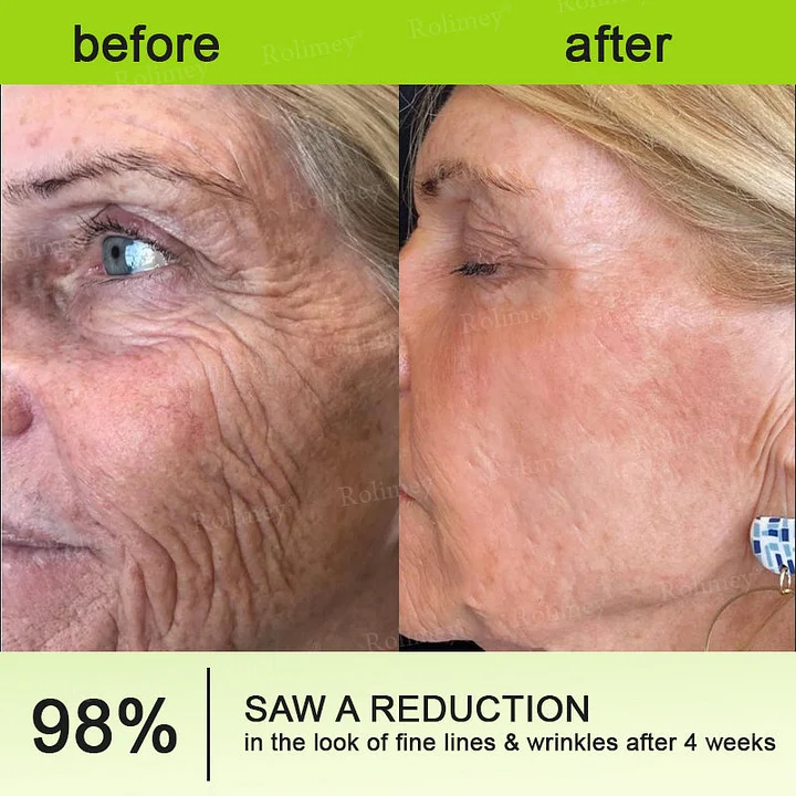 Rolimey® Botox & Vita-A Retinol Firming & Anti-Wrinkle Serum