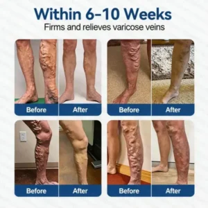 Alisanda® 𝑽𝗲𝗶𝙣 𝘾𝐨𝐧𝘁𝗼𝙪𝙧 𝙈𝙞𝐜𝐫𝒐𝒏𝒆𝗲𝗱𝗹𝙚 𝙋𝙖𝐭𝐜𝒉 𝒘𝒊𝘁𝗵 𝗔𝙙𝙫𝙖𝙣𝙘𝐞𝐝 𝐃𝒊𝒐𝒔𝗺𝙞𝐧 & 𝑯𝒆𝘀𝗽𝗲𝙧𝙞𝙙𝙞𝐧 𝐃𝒆𝒍𝒊𝒗𝗲𝗿𝙮🌿𝟕-𝐃𝐚𝐲 𝐕𝐢𝐬𝐢𝐛𝐥𝐞 𝐑𝐞𝐬𝐮𝐥𝐭𝐬 𝐟𝐨𝐫 𝐕𝐚𝐫𝐢𝐜𝐨𝐬𝐞 𝐕𝐞𝐢𝐧𝐬 — 𝗔𝗱𝘃𝗮𝗻𝗰𝗲𝗱 𝗛𝗲𝗿𝗯𝗮𝗹 𝗕𝗹𝗲𝗻𝗱 𝗧𝗮𝗿𝗴𝗲𝘁𝘀 𝗦𝗽𝗶𝗱𝗲𝗿 𝗩𝗲𝗶𝗻𝘀 & 𝗥𝗲𝗹𝗶𝗲𝘃𝗲𝘀 𝗛𝗲𝗮𝘃𝘆, 𝗧𝗶𝗿𝗲𝗱 𝗟𝗲𝗴𝘀