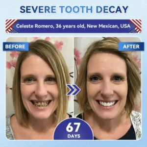 Your Smile~ SmileFitPro® 🦷 Tideglusib Fast‑Dissolving Tooth & Gum Repair Oral Strips ✨ (𝟓-𝐢𝐧-𝟏 💎 𝐑𝐞𝐛𝐮𝐢𝐥𝐝 𝐄𝐧𝐚𝐦𝐞𝐥 & 𝐃𝐞𝐧𝐭𝐢𝐧 • 𝐒𝐭𝐫𝐞𝐧𝐠𝐭𝐡𝐞𝐧 𝐆𝐮𝐦𝐬 • 𝐄𝐫𝐚𝐝𝐢𝐜𝐚𝐭𝐞 𝐓𝐚𝐫𝐭𝐚𝐫 & 𝐎𝐝𝐨𝐫 • 𝐖𝐡𝐢𝐭𝐞𝐧𝐢𝐧𝐠 • 𝐒𝐭𝐨𝐩 𝐓𝐨𝐨𝐭𝐡 𝐒𝐞𝐧𝐬𝐢𝐭𝐢𝐯𝐢𝐭𝐲)
