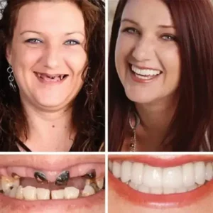 DarkFairy Custom-Fit Suction Dentures