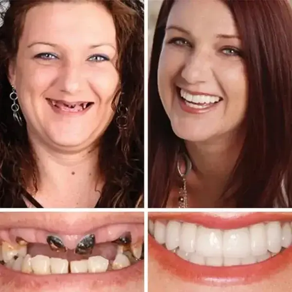 DarkFairy Custom-Fit Suction Dentures