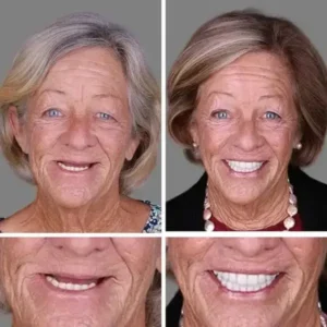 DarkFairy Custom-Fit Suction Dentures