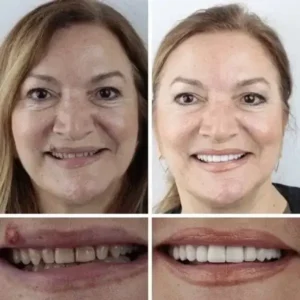 DarkFairy Custom-Fit Suction Dentures