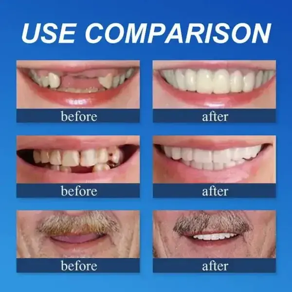 DarkFairy Custom-Fit Suction Dentures