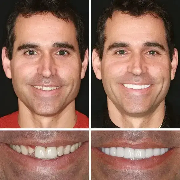 DarkFairy Custom-Fit Suction Dentures