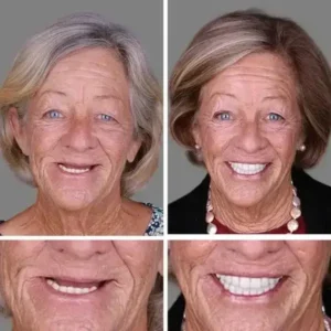 Heaceitr™ Full Denture with Strong Suction