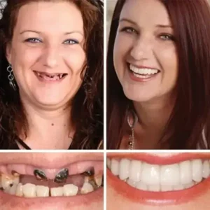 Heaceitr™ Full Denture with Strong Suction