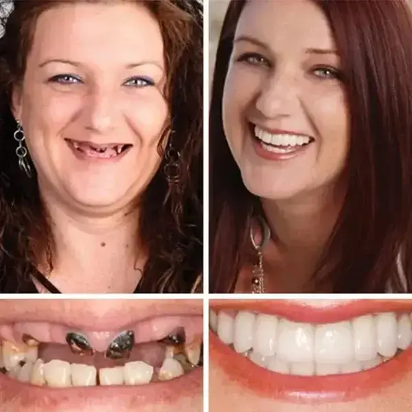 Heaceitr™ Full Denture with Strong Suction