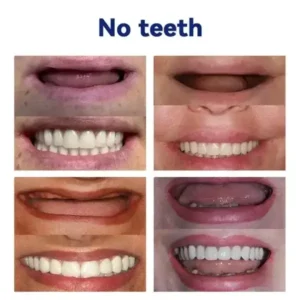Vaxflite™ Advanced Full Denture Set